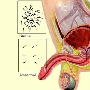  Infertility In Women 